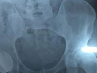 Andy Murray Undergoes Hip Surgery